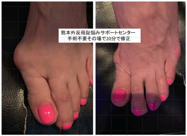 熊本外反母趾悩みサポートサロン